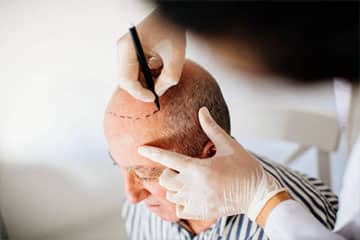 Hair Transplant in Manchester