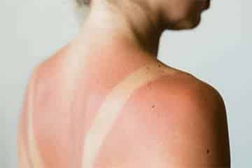 Medical and Non-Medical Approach to Sunburn